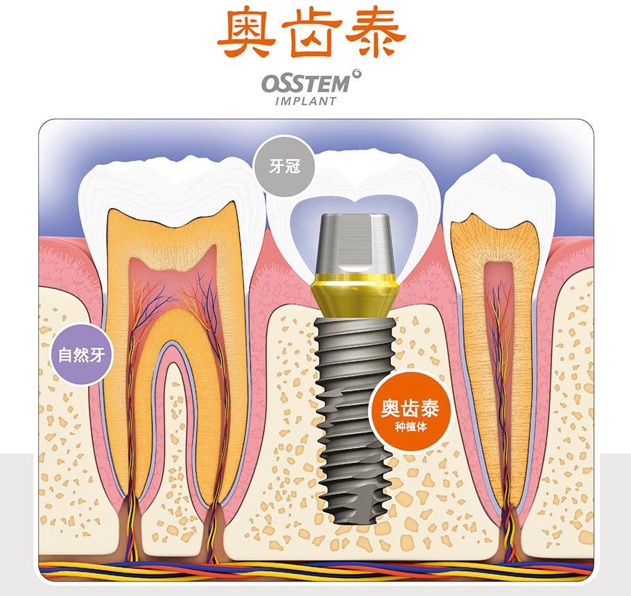 韓國奧齒泰osstem種植牙