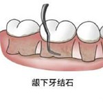 齦下刮治