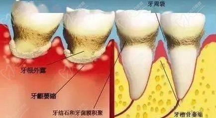 牙周疾病和牙結(jié)石