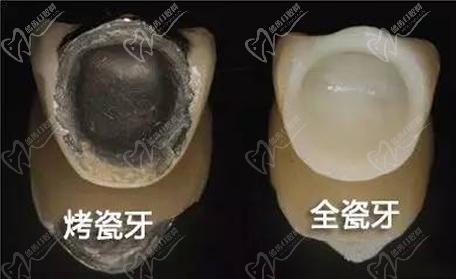 1000元的全瓷牙和1500的區(qū)別