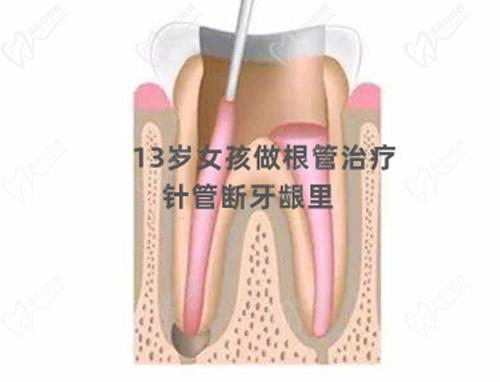 根管治療