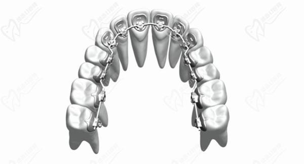 舌側(cè)矯正