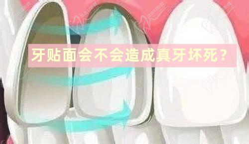 牙貼面會(huì)不會(huì)造成真牙壞死