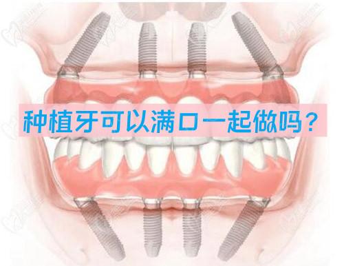 種植牙可以滿口一起做嗎