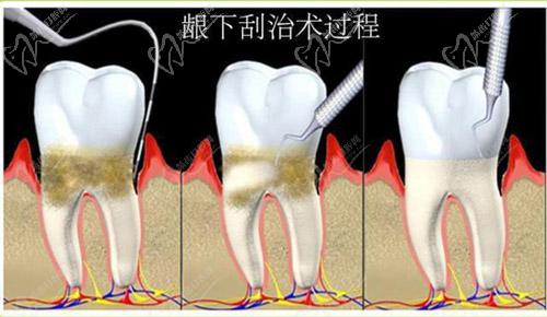 齦下刮治