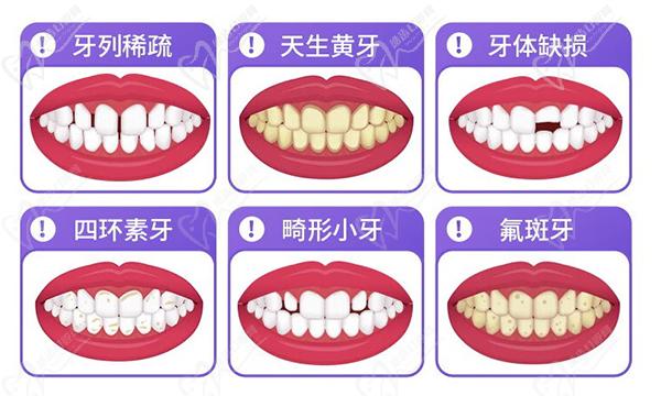 脂玉全瓷貼面適合人群