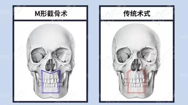 正頜直術比正頜手術會影響手術成效嗎