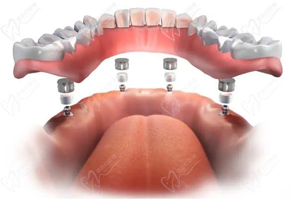 all-on-4/6滿口種植牙和滿口半固定種植牙的區(qū)別