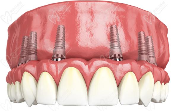西安滿口半固定種植牙價格：1.8萬-5萬左右