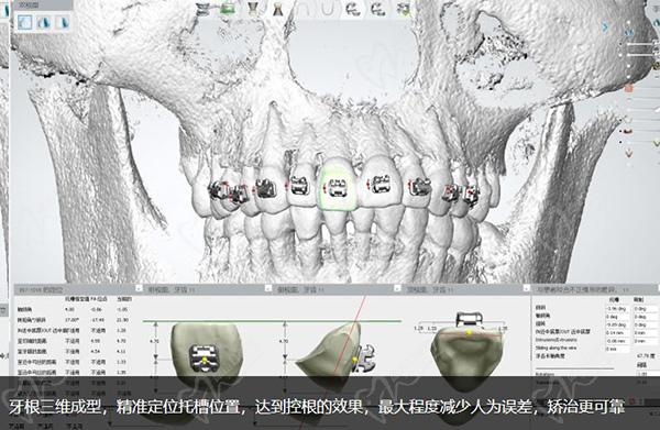 德倫口腔矯正牙齒怎么樣正畸模擬設(shè)計