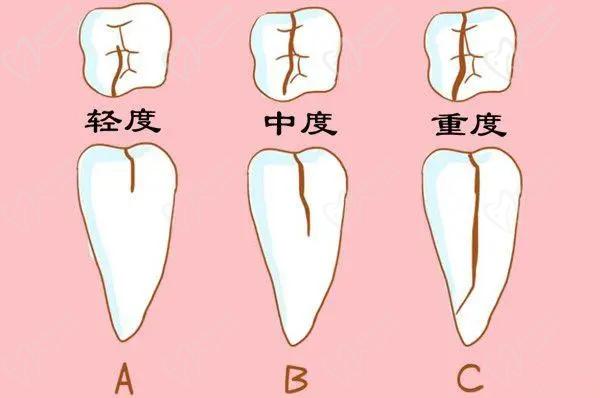 牙齒斷裂