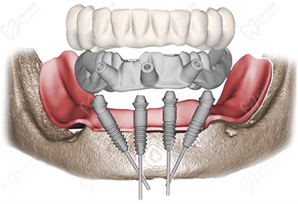 all-on-4種植牙