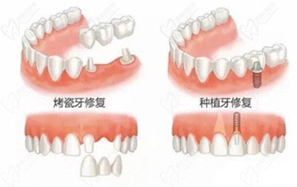 牙齒修復