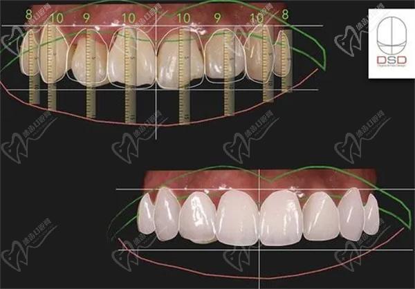 DSD牙齒美學(xué)修復(fù)技術(shù)