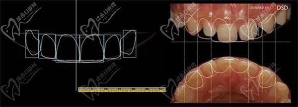 DSD牙齒美學(xué)修復(fù)技術(shù)