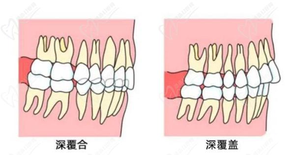 牙齒只深覆蓋正常嗎貢獻法治？深覆蓋有必要矯正嗎？看矯正后臉型變化