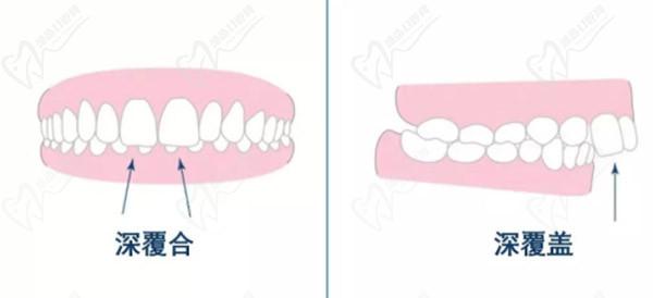 牙齒只深覆蓋正常嗎？深覆蓋有必要矯正嗎？看矯正后臉型變化