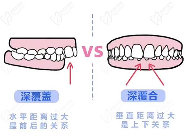 牙齒只深覆蓋正常嗎綜合運用？深覆蓋有必要矯正嗎？看矯正后臉型變化