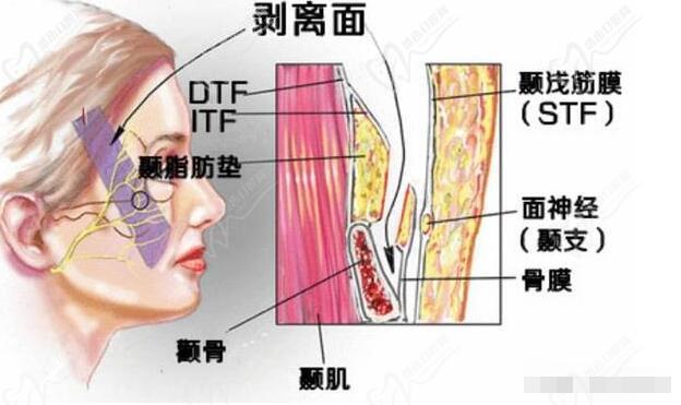 杜太超醫(yī)生的拉皮手術(shù)價格