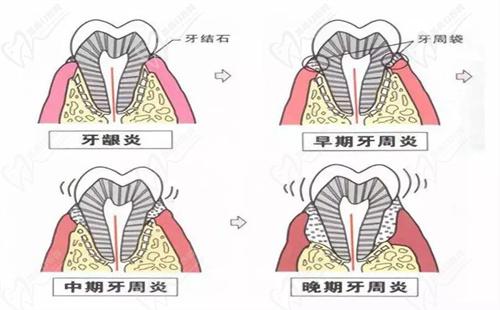 牙齦炎和牙周炎的區(qū)別是什么