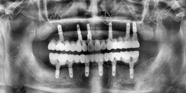 廣州鼎植口腔半口種植牙范例