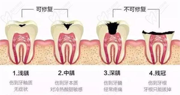 根管治療