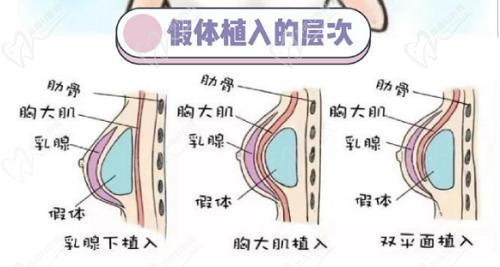 謝衛(wèi)國(guó)隆胸技術(shù)怎么樣