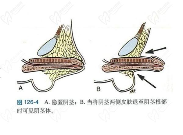 生殖延長整形手術多久有成效