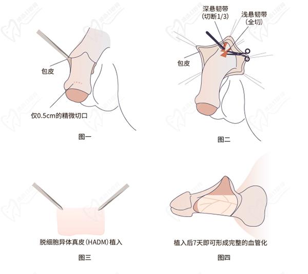 增長手術可以增長多少