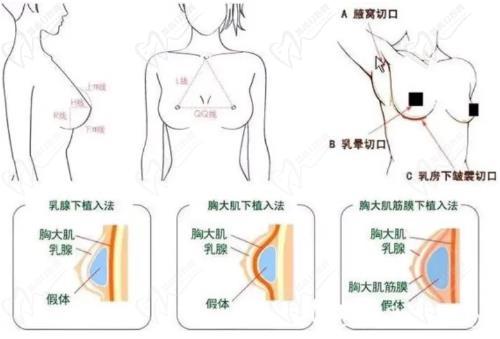 廣州黃廣香擅長隆胸手術(shù)