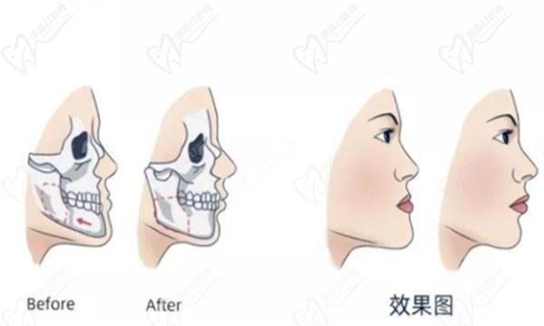 40歲能做正頜手術嗎