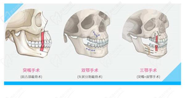 40歲能做正頜手術嗎