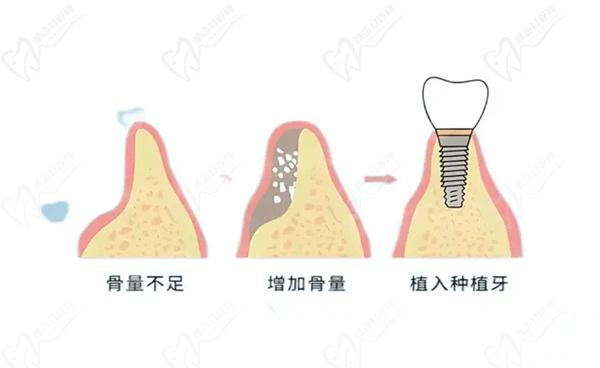 冠心病能種植牙嗎