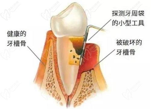 天津口腔醫(yī)院牙周炎刮治費(fèi)用