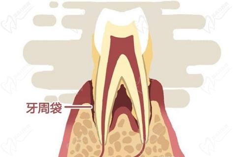 天津口腔醫(yī)院牙周炎刮治費(fèi)用