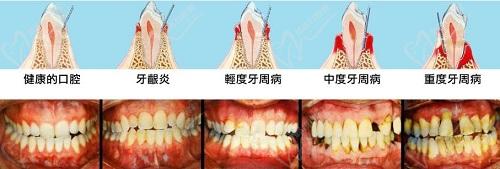 天津口腔醫(yī)院牙周炎刮治費(fèi)用