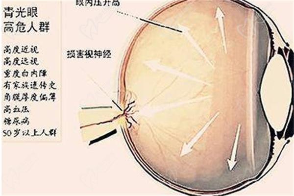 青光眼伴隨虹膜炎治療