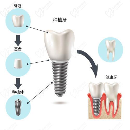 韓國登騰三代植體易普萊優(yōu)勢