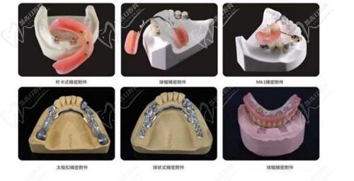 覆蓋義齒相較于傳統(tǒng)全口義齒的優(yōu)勢