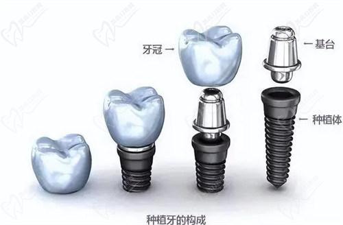 種一顆牙需要多少錢與時俱進？