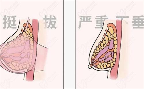 黃廣香和朱云做胸實(shí)例對比