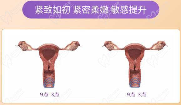 重慶做私密緊縮手術多少錢