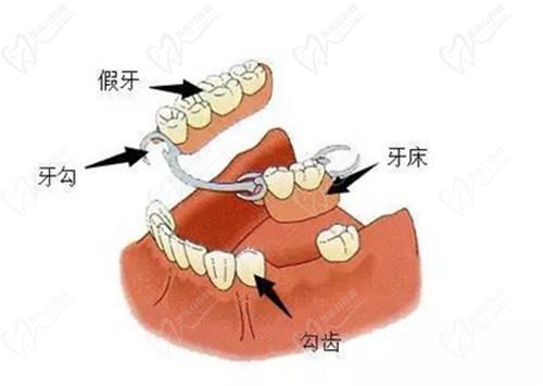 套筒冠義齒需要每天摘戴嗎？