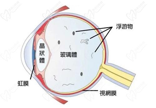 后鞏膜加固術(shù)后視力能提高多少