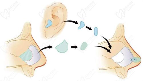 二、耳軟骨隆鼻三年吸收后求得平衡，有哪些修復(fù)方案紮實做？