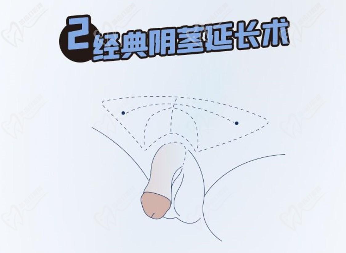 李世榮教授靠譜嗎？做延長(zhǎng)手術(shù)2-5cm/增粗3cm很靠譜空白區，出診價(jià)格高但超值